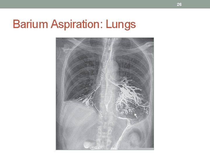 26 Barium Aspiration: Lungs 