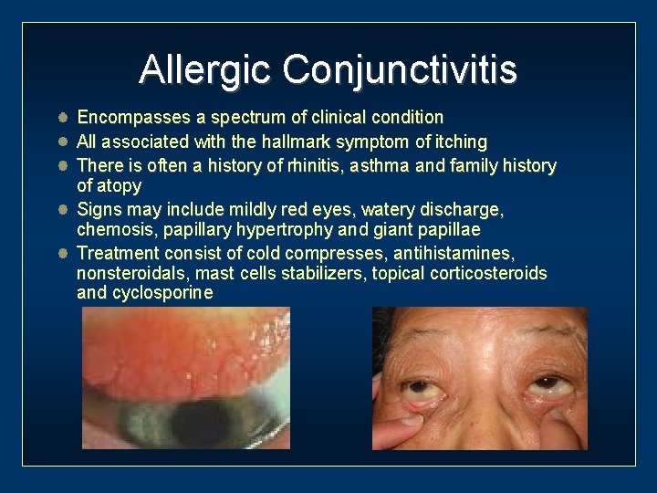 Allergic Conjunctivitis Encompasses a spectrum of clinical condition All associated with the hallmark symptom