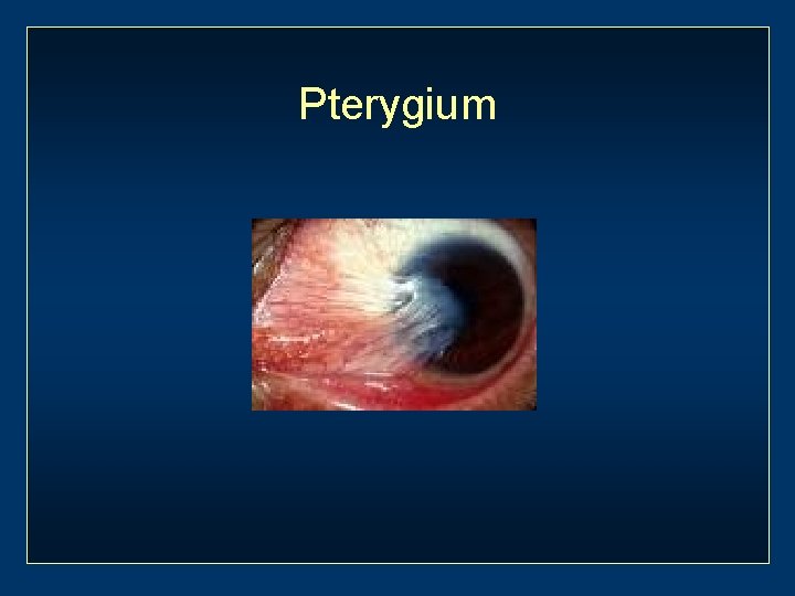 Pterygium 