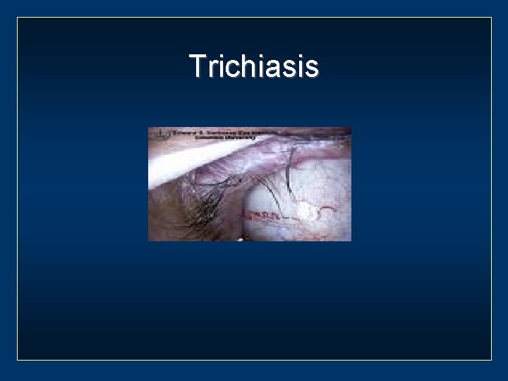 Trichiasis 