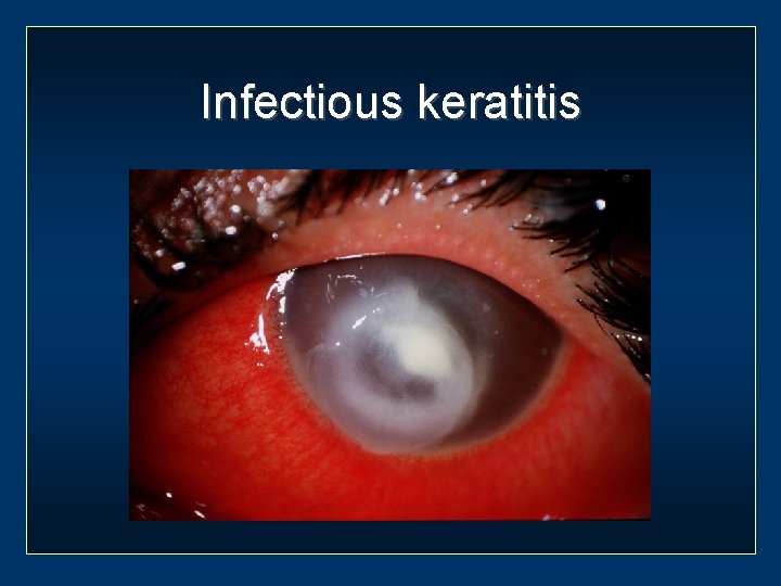 Infectious keratitis 