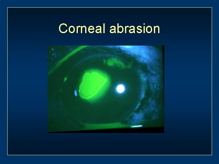 Corneal abrasion 