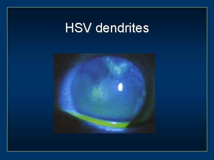 HSV dendrites 