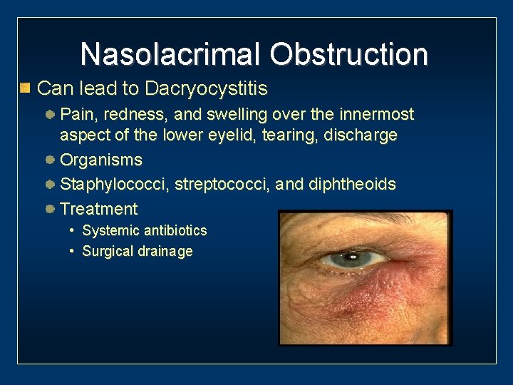 Nasolacrimal Obstruction Can lead to Dacryocystitis Pain, redness, and swelling over the innermost aspect