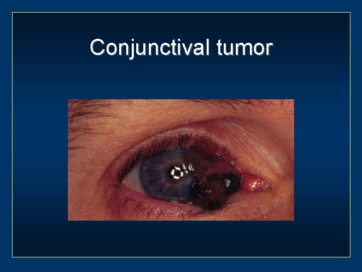 Conjunctival tumor 