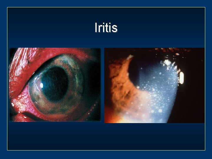 Iritis 