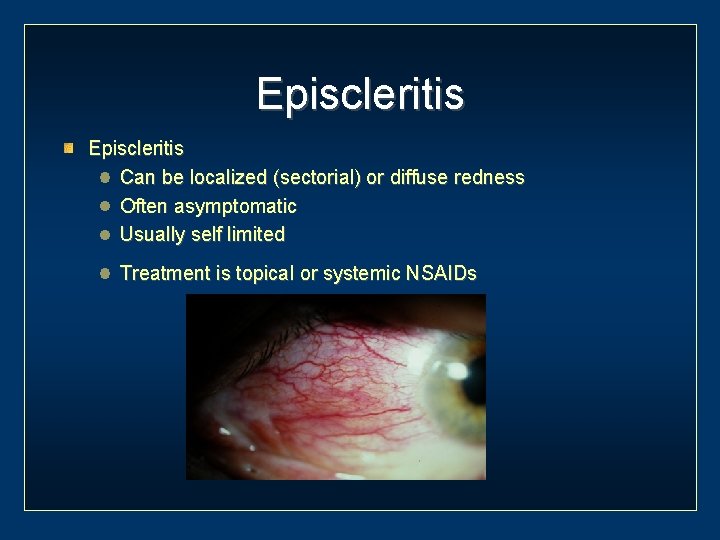 Episcleritis Can be localized (sectorial) or diffuse redness Often asymptomatic Usually self limited Treatment