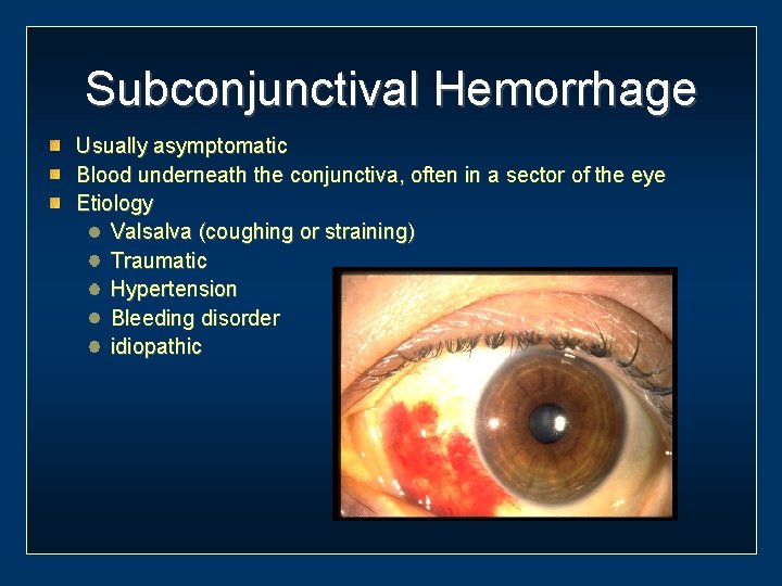 Subconjunctival Hemorrhage Usually asymptomatic Blood underneath the conjunctiva, often in a sector of the