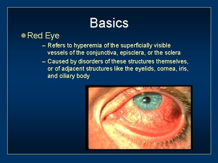 Red Eye Basics – Refers to hyperemia of the superficially visible vessels of the