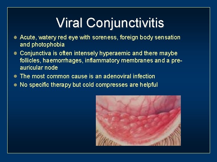 Viral Conjunctivitis Acute, watery red eye with soreness, foreign body sensation and photophobia Conjunctiva