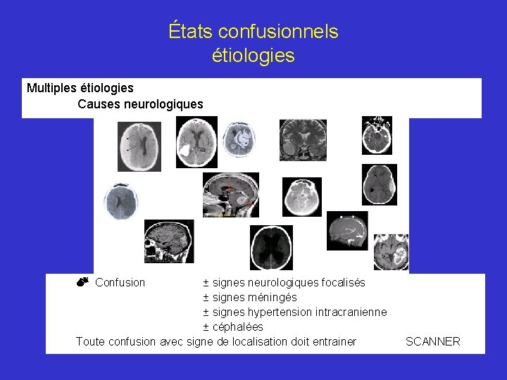 États confusionnels étiologies Multiples étiologies Causes neurologiques ± signes neurologiques focalisés ± signes méningés