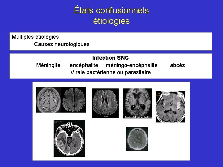 États confusionnels étiologies Multiples étiologies Causes neurologiques Infection SNC Méningite encéphalite méningo-encéphalite Virale bactérienne