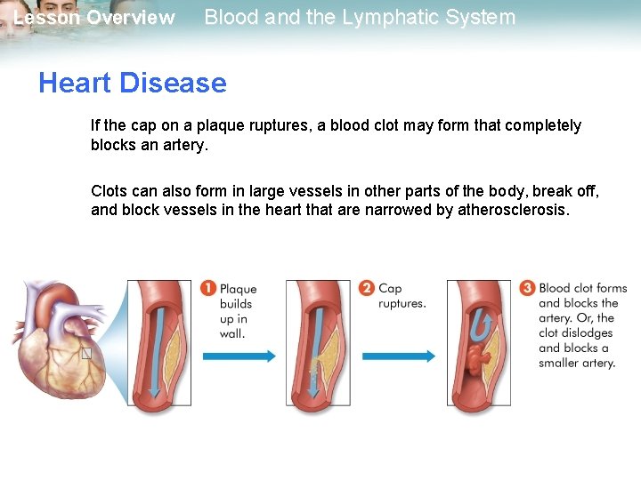 Lesson Overview Blood and the Lymphatic System Heart Disease If the cap on a
