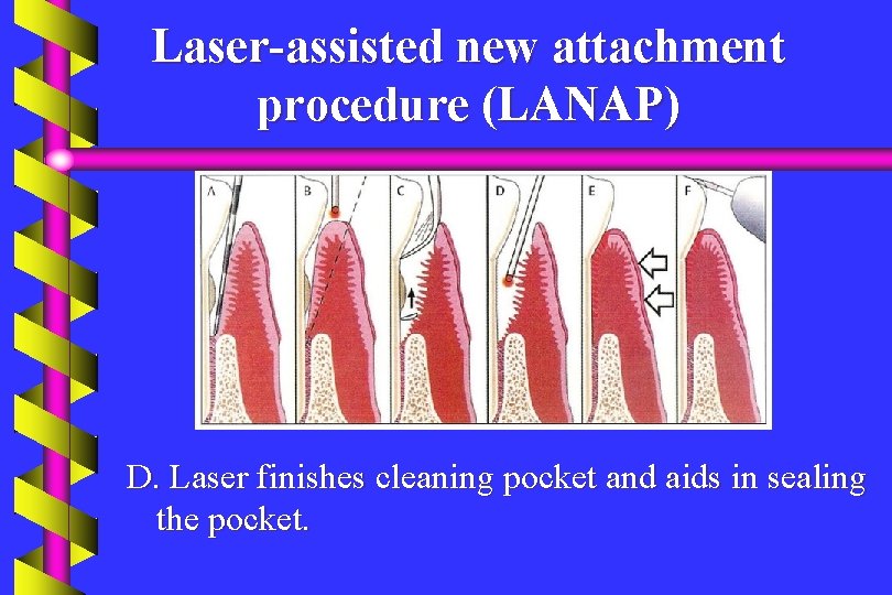 Laser-assisted new attachment procedure (LANAP) D. Laser finishes cleaning pocket and aids in sealing