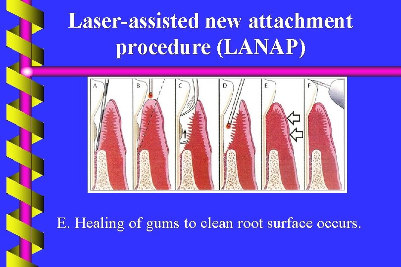 Laser-assisted new attachment procedure (LANAP) E. Healing of gums to clean root surface occurs.