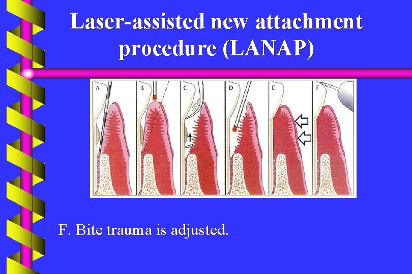 Laser-assisted new attachment procedure (LANAP) F. Bite trauma is adjusted. 