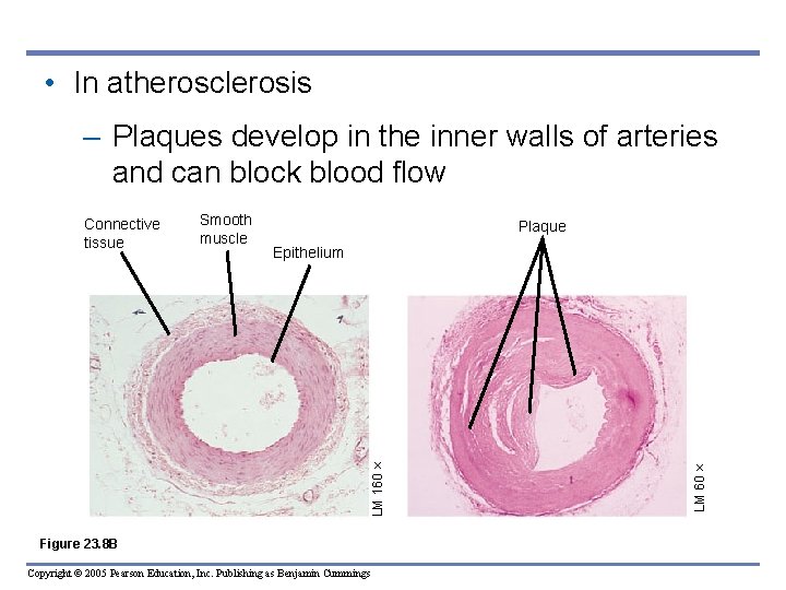  • In atherosclerosis – Plaques develop in the inner walls of arteries and