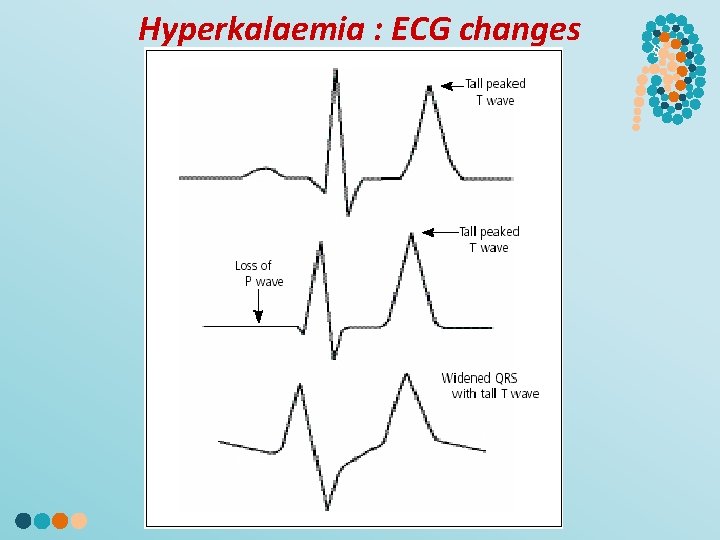 Hyperkalaemia : ECG changes § 