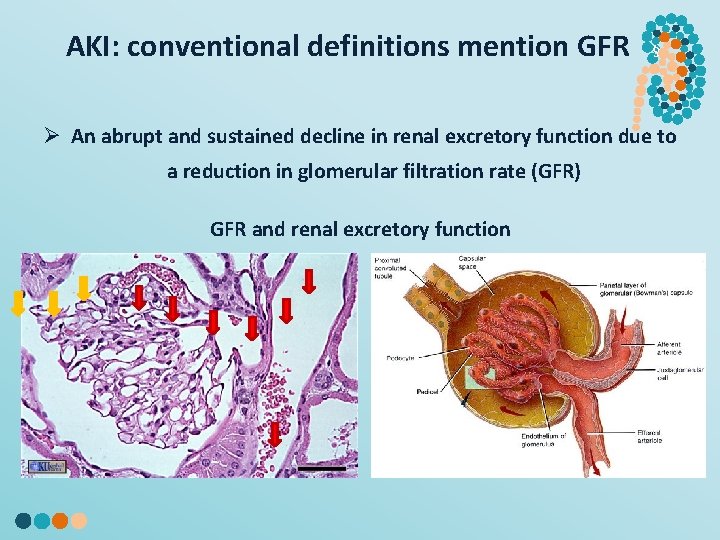 AKI: conventional definitions mention GFR § Ø An abrupt and sustained decline in renal