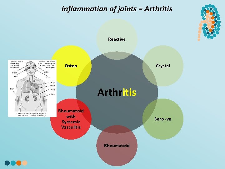 Inflammation of joints = Arthritis Reactive Osteo Crystal Arthritis Rheumatoid with Systemic Vasculitis Sero