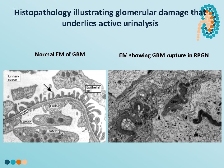 Histopathology illustrating glomerular damage that§ underlies active urinalysis Normal EM of GBM EM showing