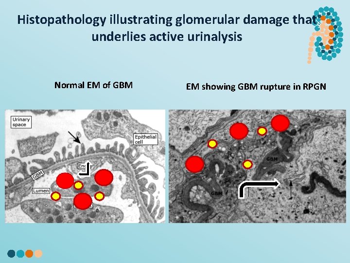 Histopathology illustrating glomerular damage that§ underlies active urinalysis Normal EM of GBM EM showing