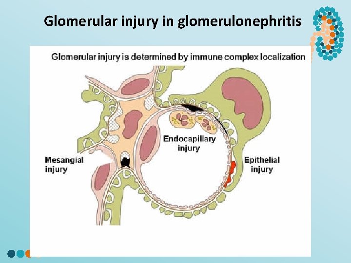 Glomerular injury in glomerulonephritis § 