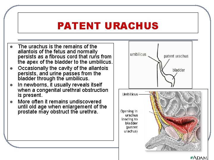 PATENT URACHUS l l The urachus is the remains of the allantois of the