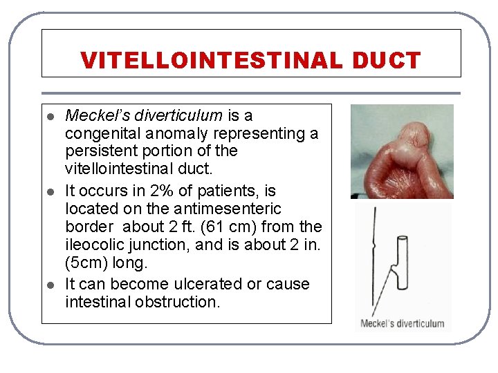 VITELLOINTESTINAL DUCT l l l Meckel’s diverticulum is a congenital anomaly representing a persistent