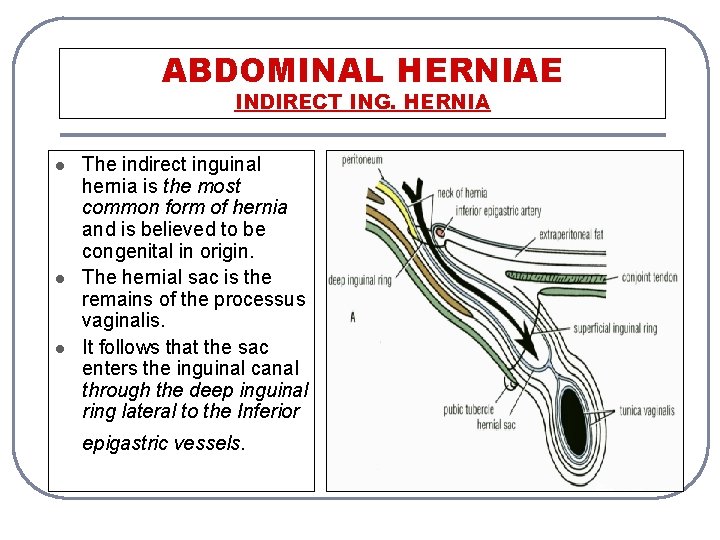 ABDOMINAL HERNIAE INDIRECT ING. HERNIA l l l The indirect inguinal hernia is the