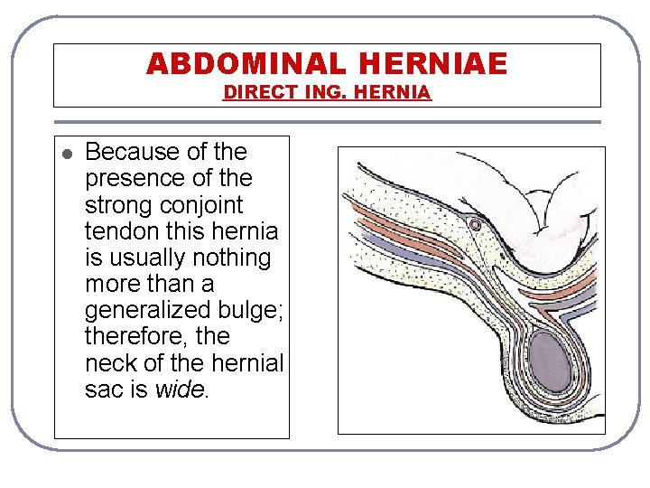 ABDOMINAL HERNIAE DIRECT ING. HERNIA l Because of the presence of the strong conjoint