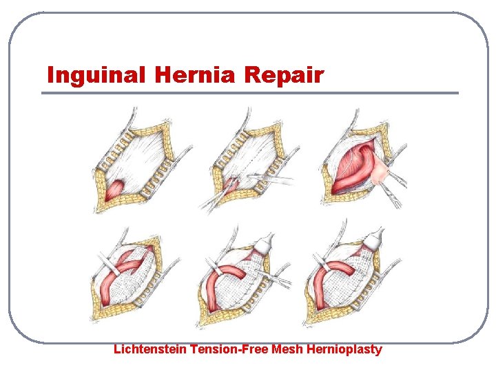 Inguinal Hernia Repair Lichtenstein Tension-Free Mesh Hernioplasty 