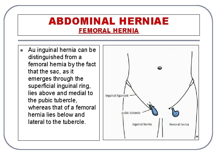 ABDOMINAL HERNIAE FEMORAL HERNIA l Au inguinal hernia can be distinguished from a femoral