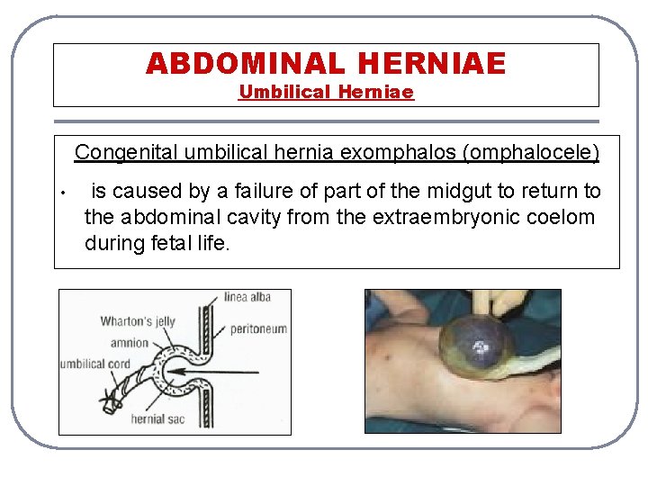 ABDOMINAL HERNIAE Umbilical Herniae Congenital umbilical hernia exomphalos (omphalocele) • is caused by a