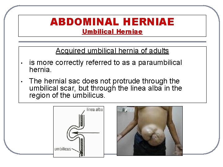 ABDOMINAL HERNIAE Umbilical Herniae Acquired umbilical hernia of adults • is more correctly referred
