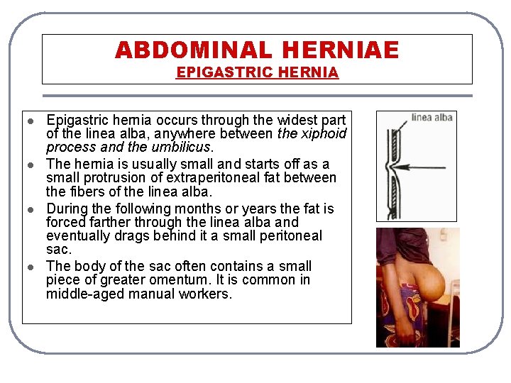 ABDOMINAL HERNIAE EPIGASTRIC HERNIA l l Epigastric hernia occurs through the widest part of