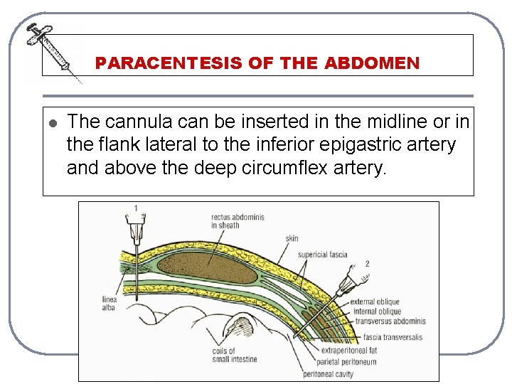 PARACENTESIS OF THE ABDOMEN l The cannula can be inserted in the midline or