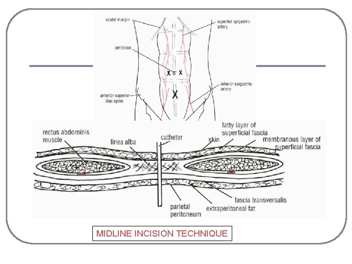 MIDLINE INCISION TECHNIQUE 