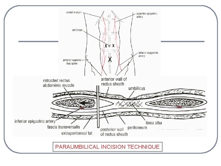 PARAUMBILICAL INCISION TECHNIQUE 