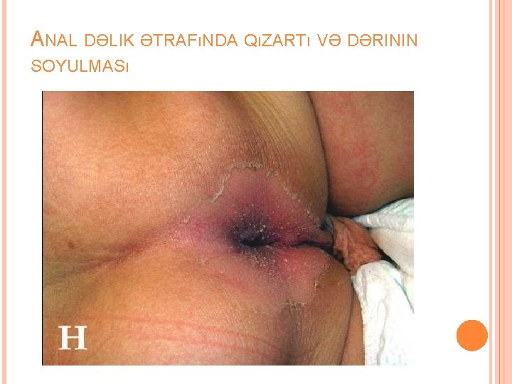 ANAL DƏLIK ƏTRAFıNDA QıZARTı VƏ DƏRININ SOYULMASı 