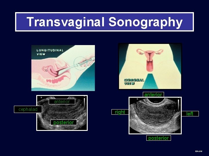 Transvaginal Sonography anterior cephalad right left posterior ©AIUM 
