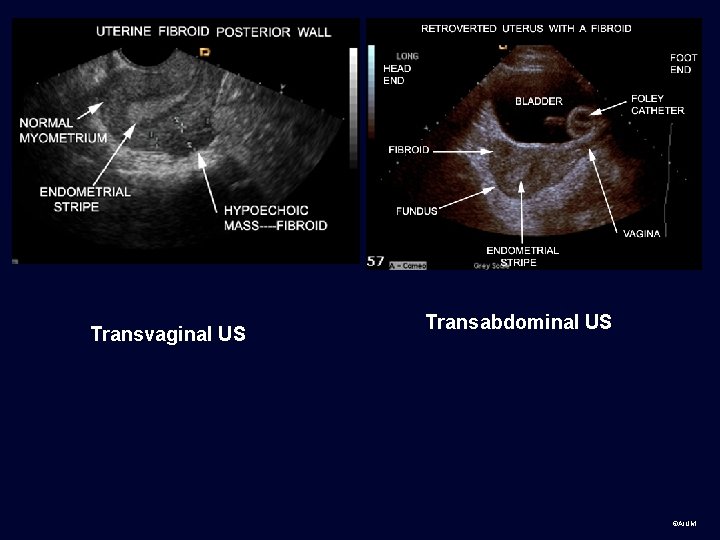 Transvaginal US Transabdominal US ©AIUM 