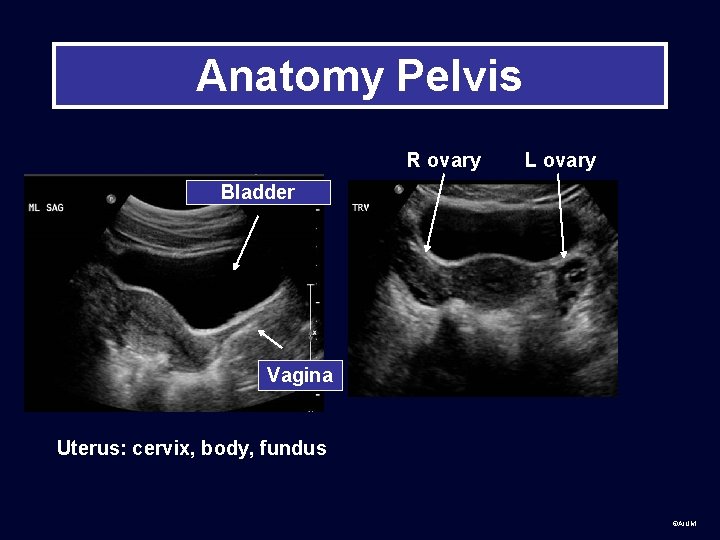 Anatomy Pelvis R ovary L ovary Bladder Vagina Uterus: cervix, body, fundus ©AIUM 