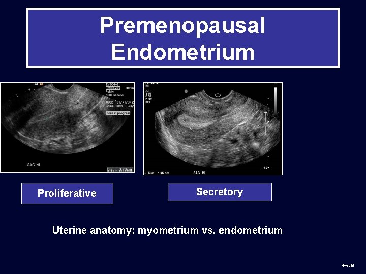 Premenopausal Endometrium Proliferative Secretory Uterine anatomy: myometrium vs. endometrium ©AIUM 