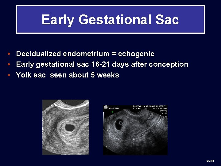 Early Gestational Sac • Decidualized endometrium = echogenic • Early gestational sac 16 -21