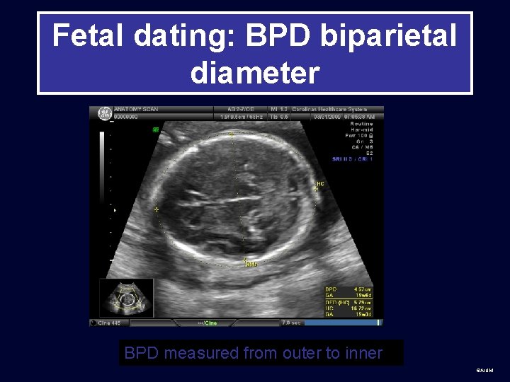 Fetal dating: BPD biparietal diameter BPD measured from outer to inner ©AIUM 