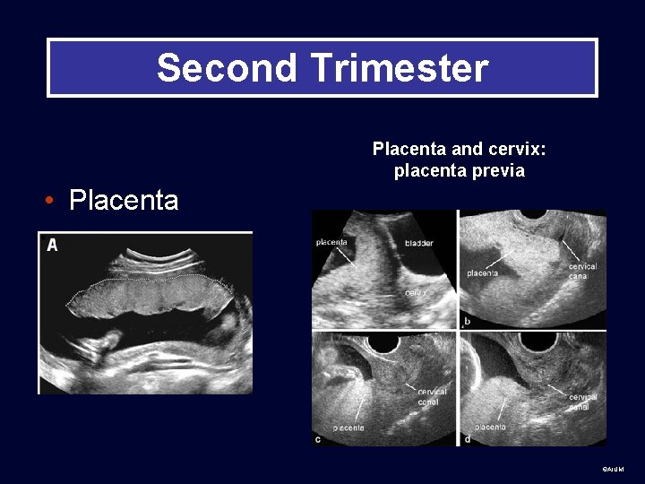 Second Trimester Placenta and cervix: placenta previa • Placenta ©AIUM 