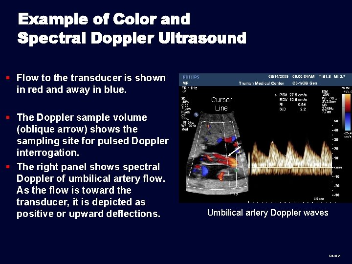 Example of Color and Spectral Doppler Ultrasound § Flow to the transducer is shown