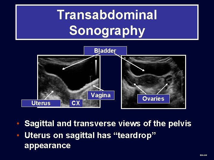 Transabdominal Sonography Bladder Vagina Uterus CX Ovaries • Sagittal and transverse views of the
