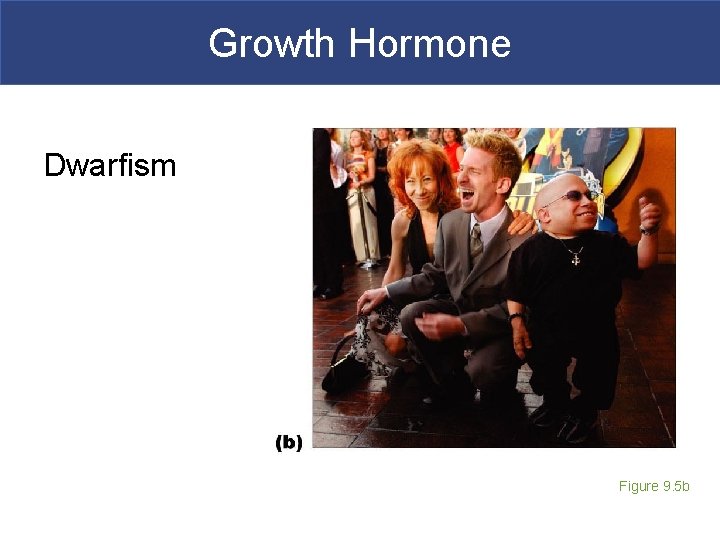 Growth Hormone Dwarfism Figure 9. 5 b 